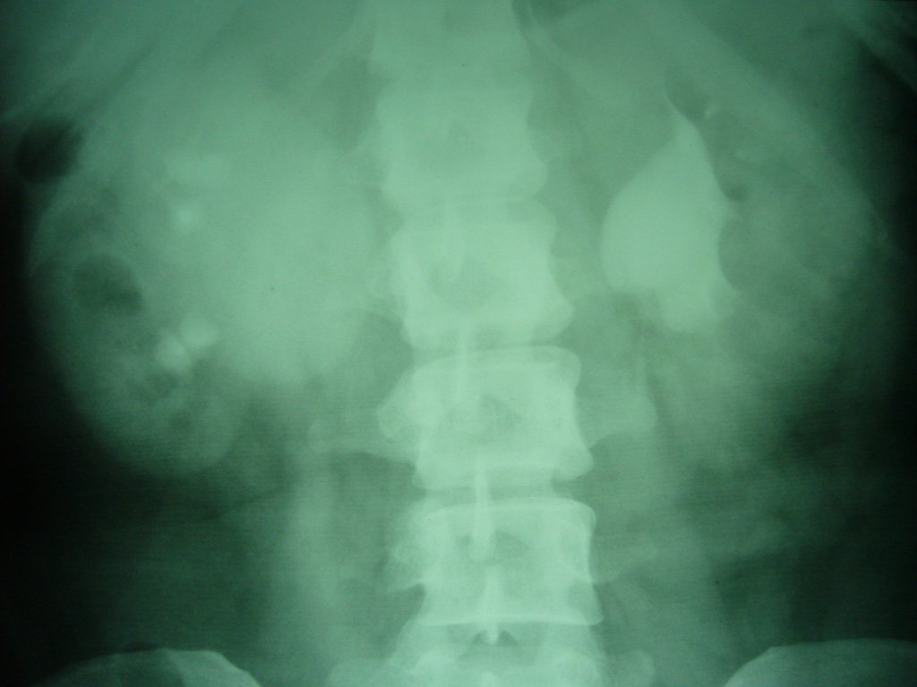 PUJ with Stones | Southern African Endourology Society