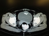 Adeno Carcinoma Bladder 1