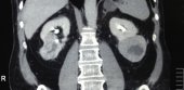 Bilateral RCC