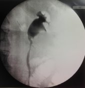 Post-op Retrograde Left