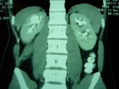 Calyceal Diverticulum 1b