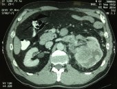 CT scan of RCC with renal vein thrombus