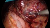 Drainage Cyst Hematoma 2