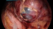 Drainage Cyst Hematoma 3