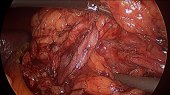 Expose Renal Pelvis