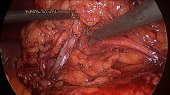 Incise Renal Pelvis