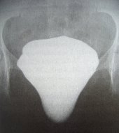 Large Cystocele