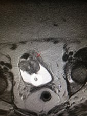 Leiomyosarcoma Bladder on MRI