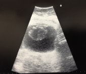 Leiomyosarcoma Bladder on U-S
