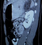 Malignant paraganglioma removed laparoscopically