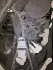 Malignant paraganglioma removed laparoscopically
