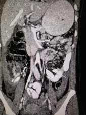 Malignant paraganglioma removed laparoscopically