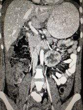 Malignant paraganglioma removed laparoscopically