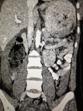 Malignant paraganglioma removed laparoscopically