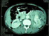 Large Renal Cell Cancer Treated Laparoscopically
