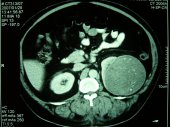 Renal Cell Cancer