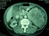Renal Cell Cancer