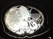 RCC with Pulmonary Metastasis 1