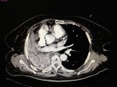 RCC with Pulmonary Metastasis 2