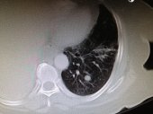 RCC with Pulmonary Metastasis 3