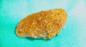 Renal Pelvis Stone 1c