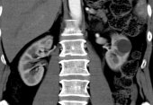 Small Cortical Renal Tumor with 3D Angiography