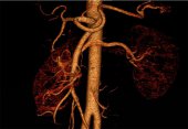 Small Cortical Renal Tumor with 3D Angiography