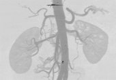 Small Cortical Renal Tumor with 3D Angiography