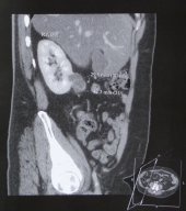 Small Renal Tumor
