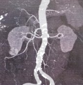 Small Renal Tumor