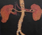 Small Renal Tumor