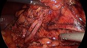 Suture Pyelotomy Incision
