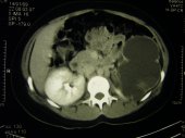 Ureterocele
