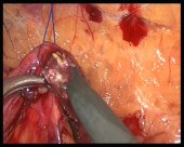 ureterolithotomy 3